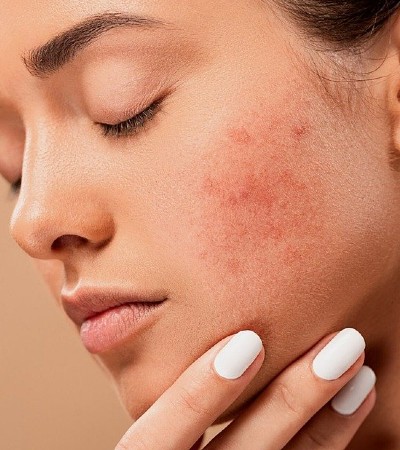 Consejos para reducir el acné