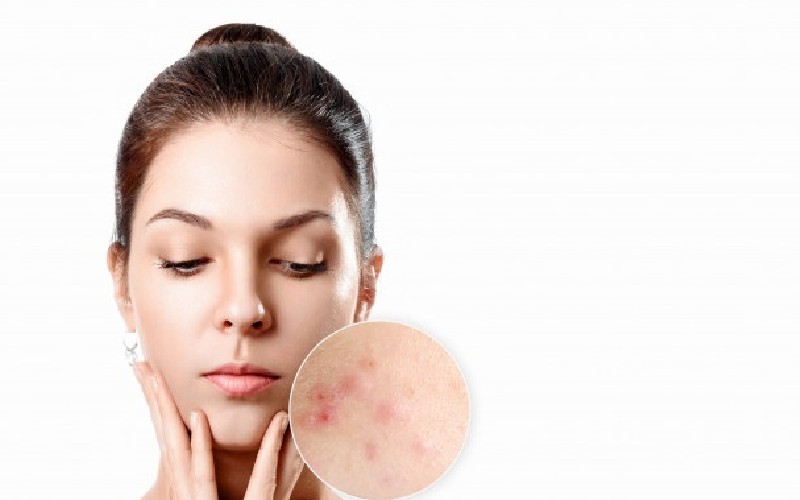 Consejos para reducir el acné